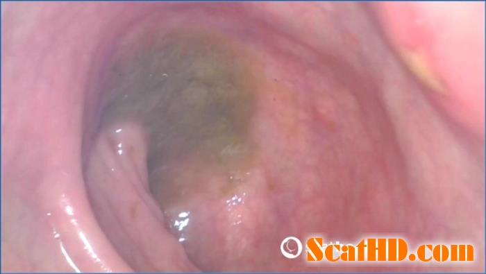 Intense Anal Gaping with Tinker Star in FullHD 1080p